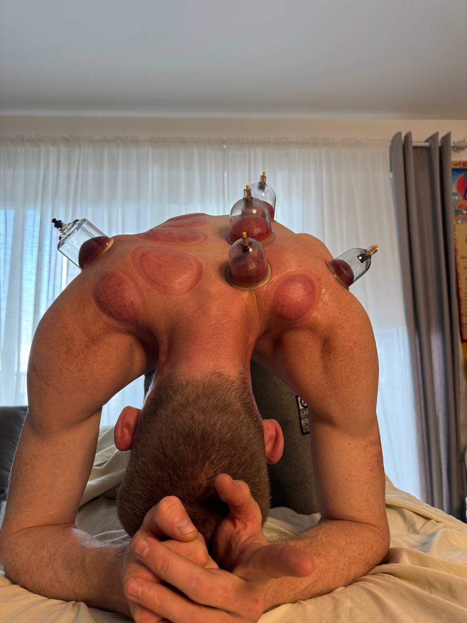 Daroma Wellness — Myofascial decompression — cups placed across the upper back